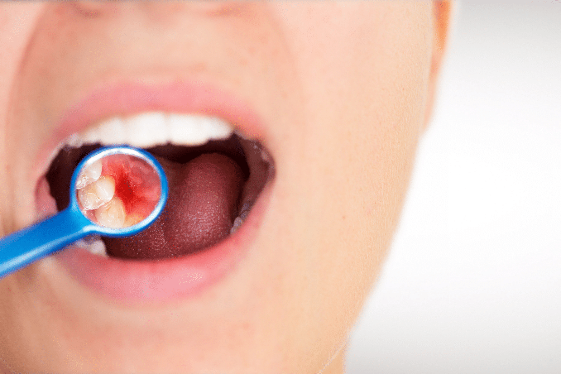 WATCH FOR WITH GUM DISEASE